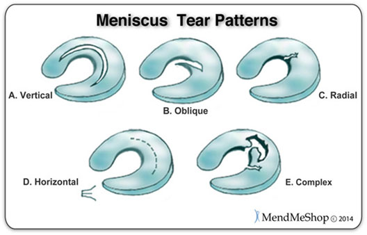 Anatomy Of An Injury Meniscus Injuries Dynasty Nerds